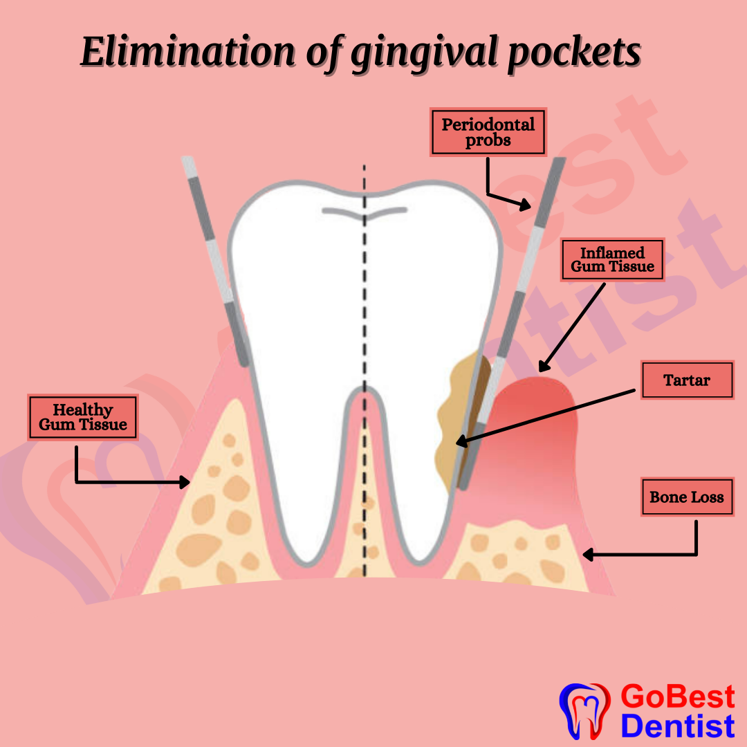 Flap Surgery & Gum Treatments