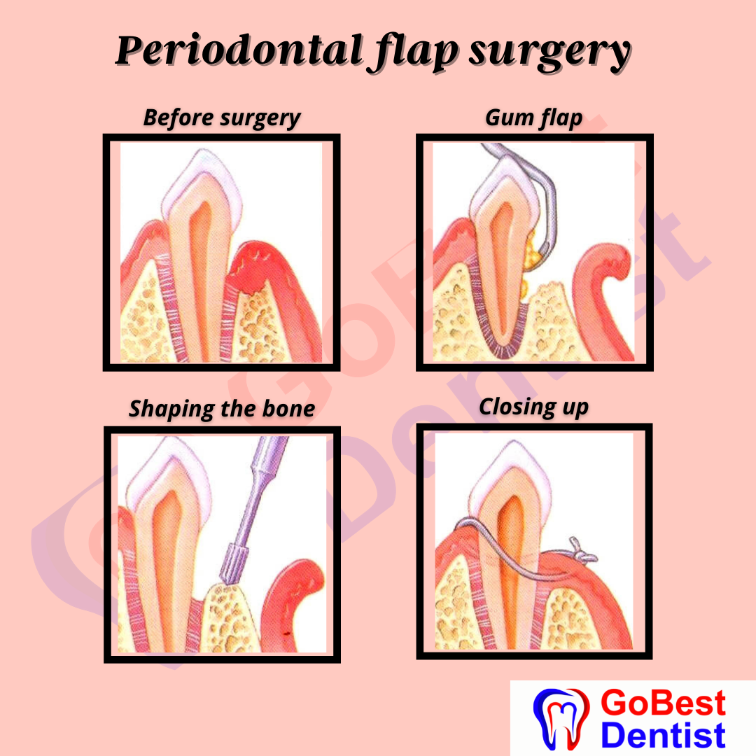 Flap Surgery & Gum Treatments