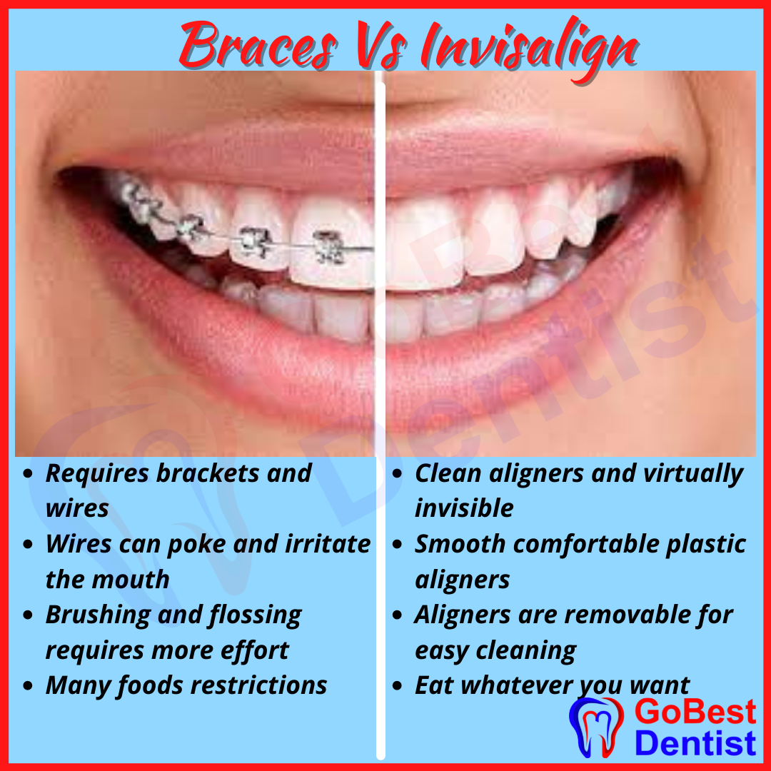 Should I Get Invisalign (Clear Aligners) or Braces?