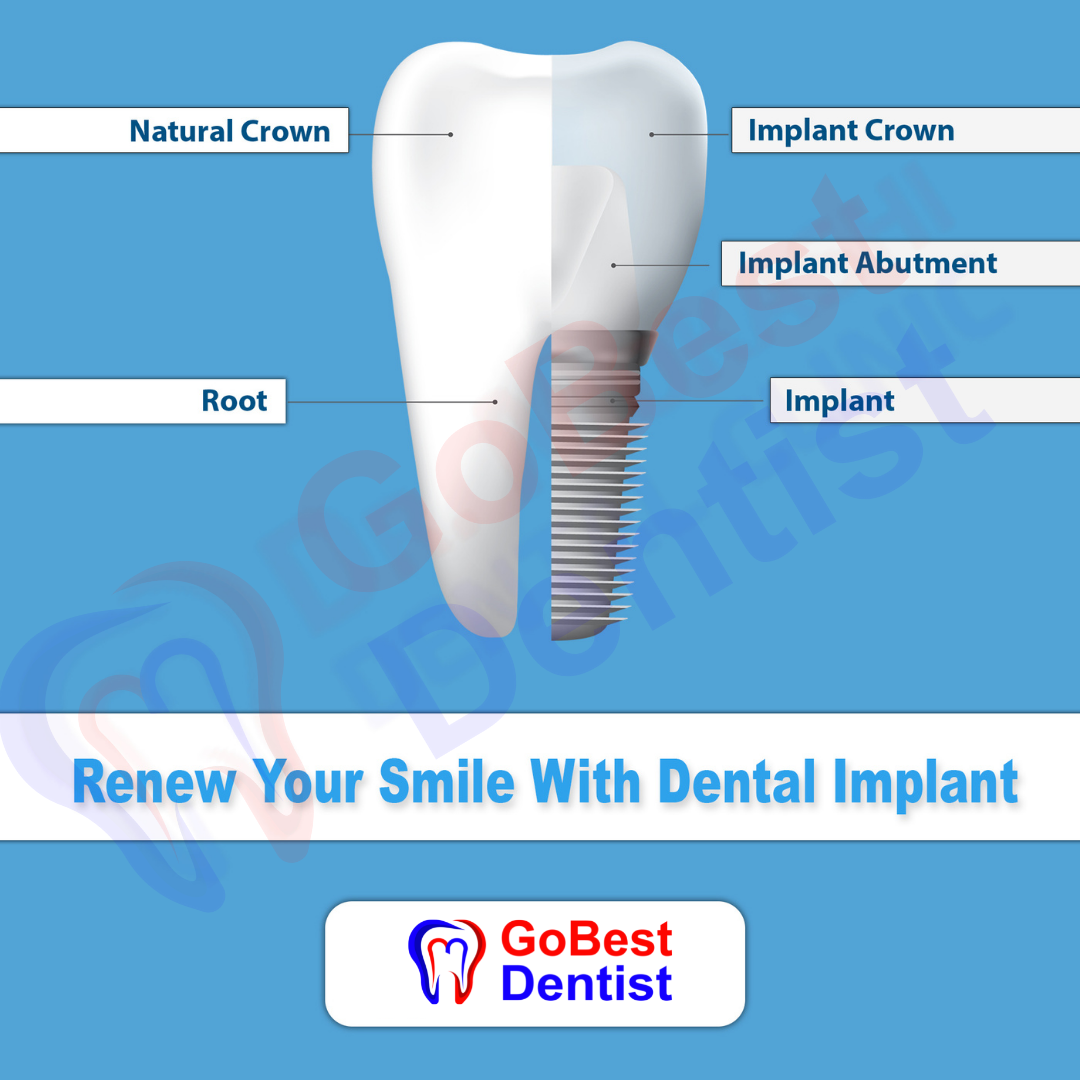 Implant